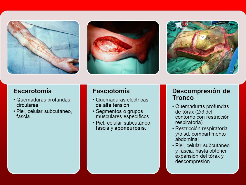 Escarotomía Quemaduras profundas circulares. Piel, celular subcutáneo, fascia. Fasciotomía. Quemaduras eléctricas de alta tensión.