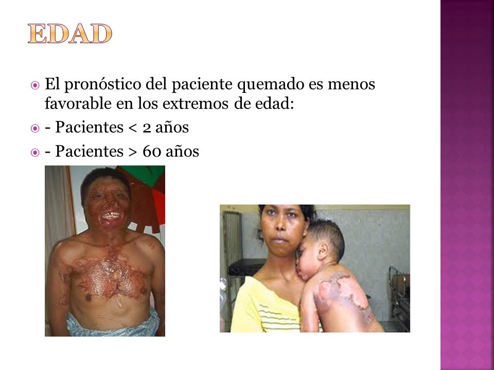 EDAD El pronóstico del paciente quemado es menos favorable en los extremos de edad: - Pacientes < 2 años.