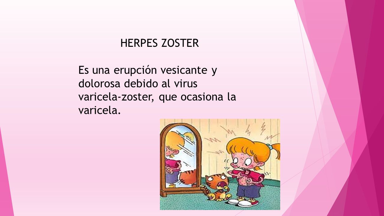 HERPES ZOSTER Es una erupción vesicante y dolorosa debido al virus varicela-zoster, que ocasiona la varicela.