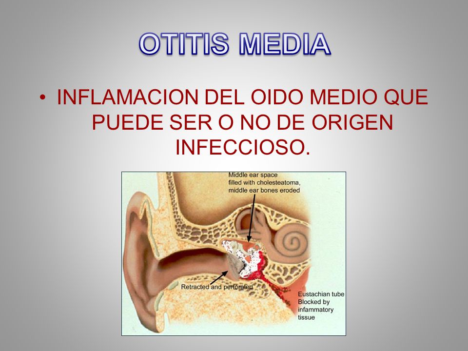 INFLAMACION DEL OIDO MEDIO QUE PUEDE SER O NO DE ORIGEN INFECCIOSO.