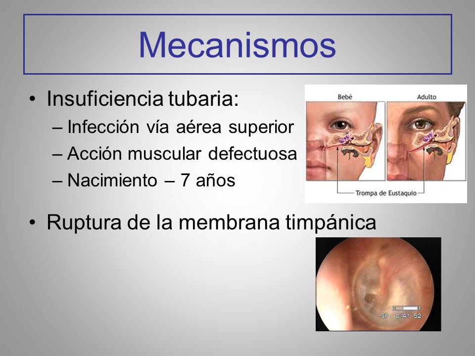 Mecanismos Insuficiencia tubaria: Ruptura de la membrana timpánica