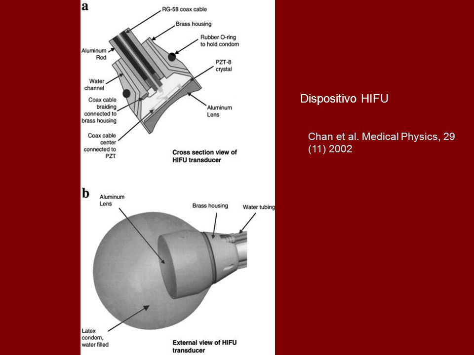 Dispositivo HIFU Chan et al. Medical Physics, 29 (11) 2002