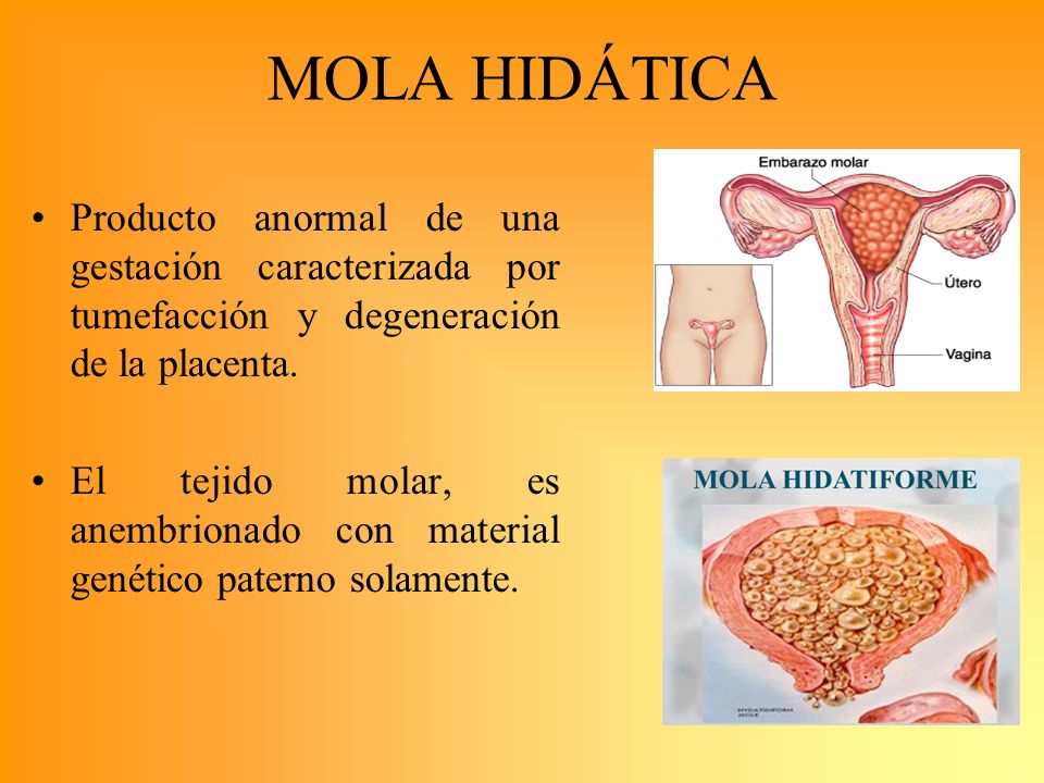 MOLA HIDÁTICA Producto anormal de una gestación caracterizada por tumefacción y degeneración de la placenta.