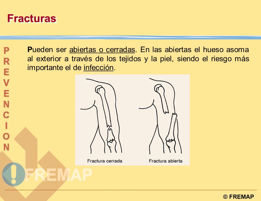 Fracturas