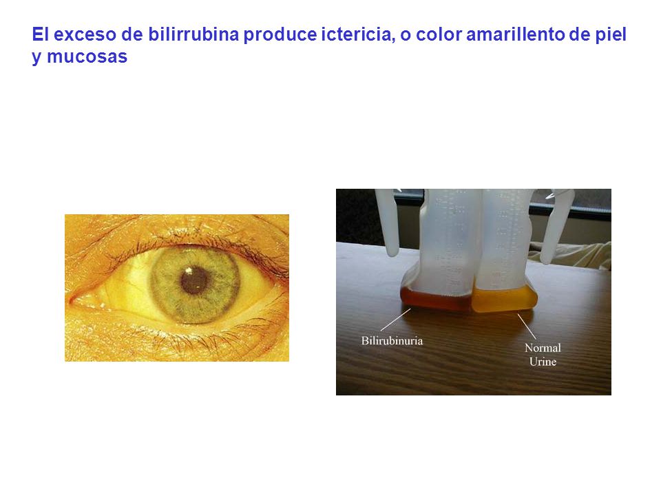 El exceso de bilirrubina produce ictericia, o color amarillento de piel y mucosas