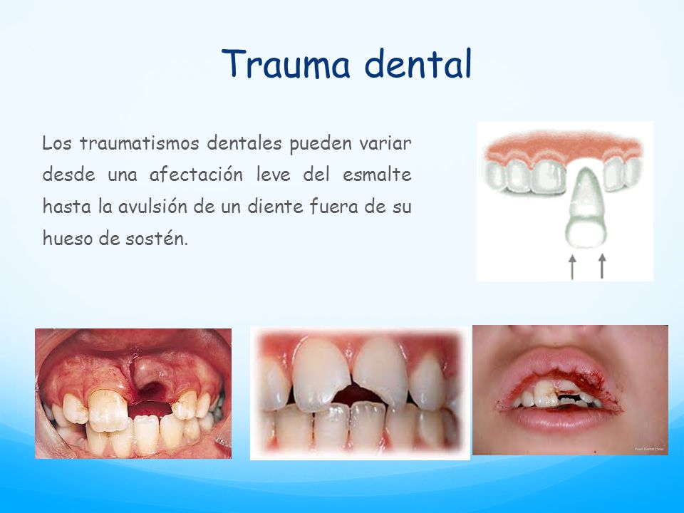 Trauma dental