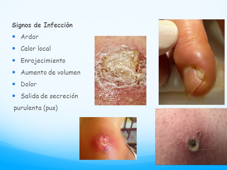 Signos de Infección Ardor. Calor local. Enrojecimiento. Aumento de volumen. Dolor. Salida de secreción.