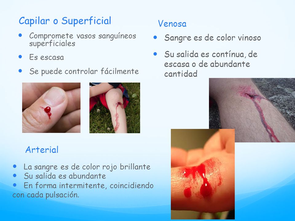 Capilar o Superficial Venosa Arterial Sangre es de color vinoso