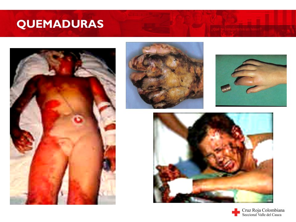 QUEMADURAS
