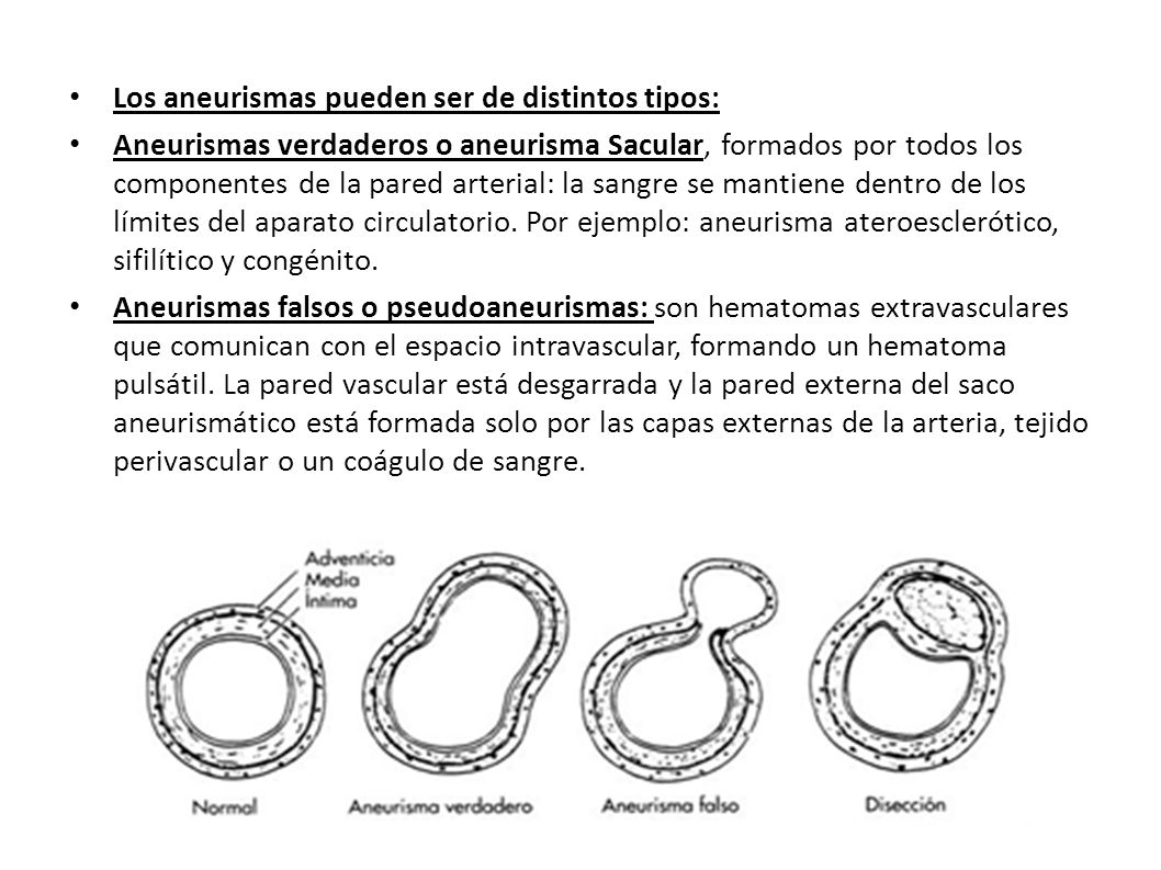 Los aneurismas pueden ser de distintos tipos: