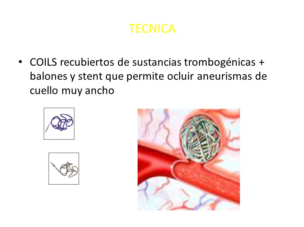 TECNICA COILS recubiertos de sustancias trombogénicas + balones y stent que permite ocluir aneurismas de cuello muy ancho.