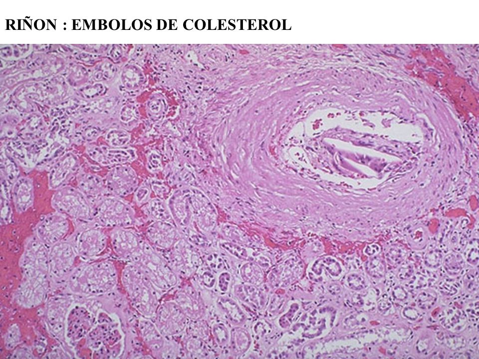 RIÑON : EMBOLOS DE COLESTEROL