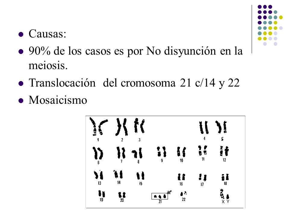 Causas: 90% de los casos es por No disyunción en la meiosis. Translocación del cromosoma 21 c/14 y 22.