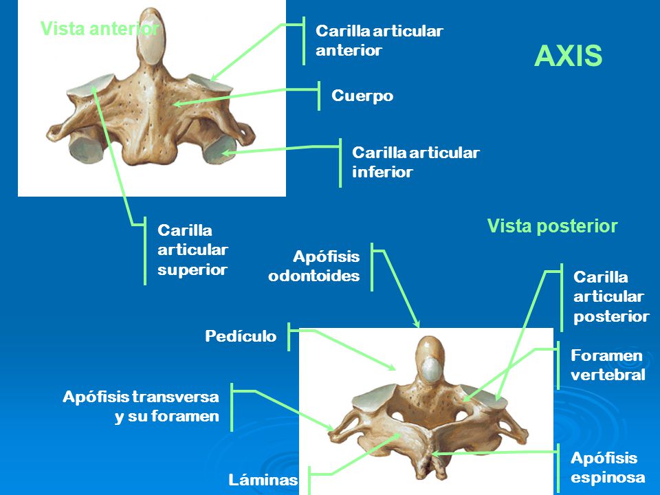 AXIS Vista anterior Vista posterior Carilla articular anterior Cuerpo