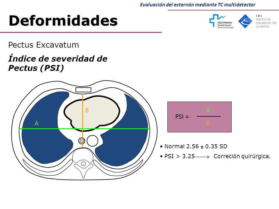 Deformidades Pectus Excavatum Índice de severidad de Pectus (PSI) A B