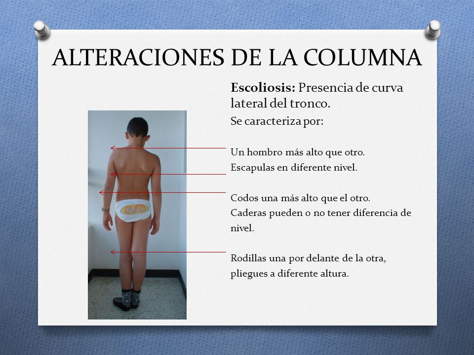 ALTERACIONES DE LA COLUMNA