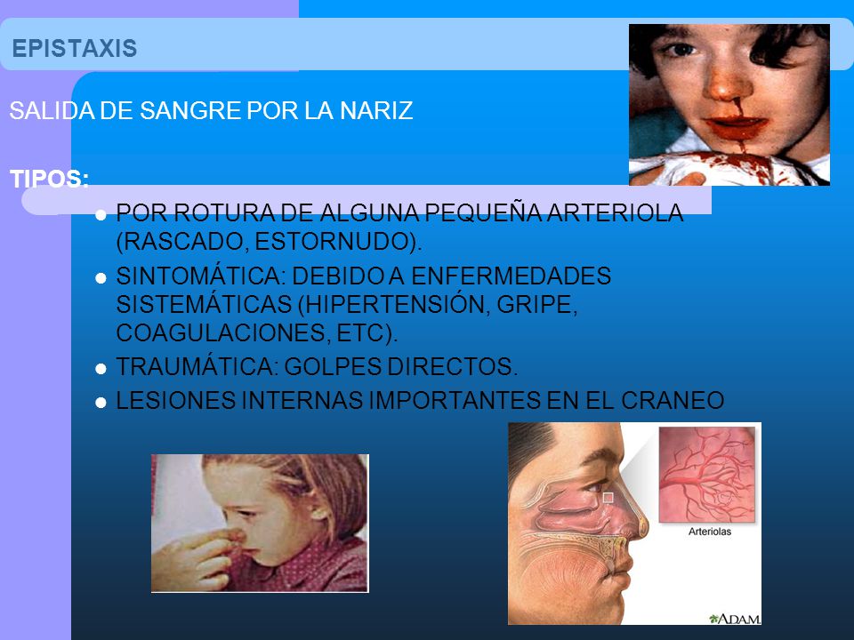 EPISTAXIS SALIDA DE SANGRE POR LA NARIZ. TIPOS: POR ROTURA DE ALGUNA PEQUEÑA ARTERIOLA (RASCADO, ESTORNUDO).