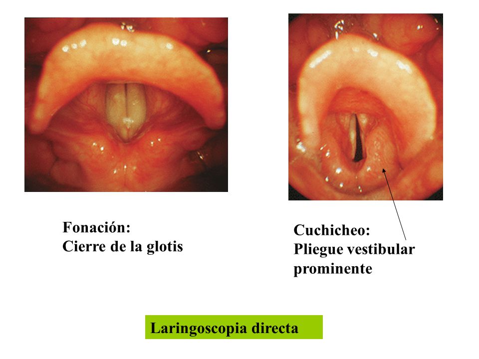 Fonación: Cierre de la glotis Cuchicheo: Pliegue vestibular prominente Laringoscopia directa