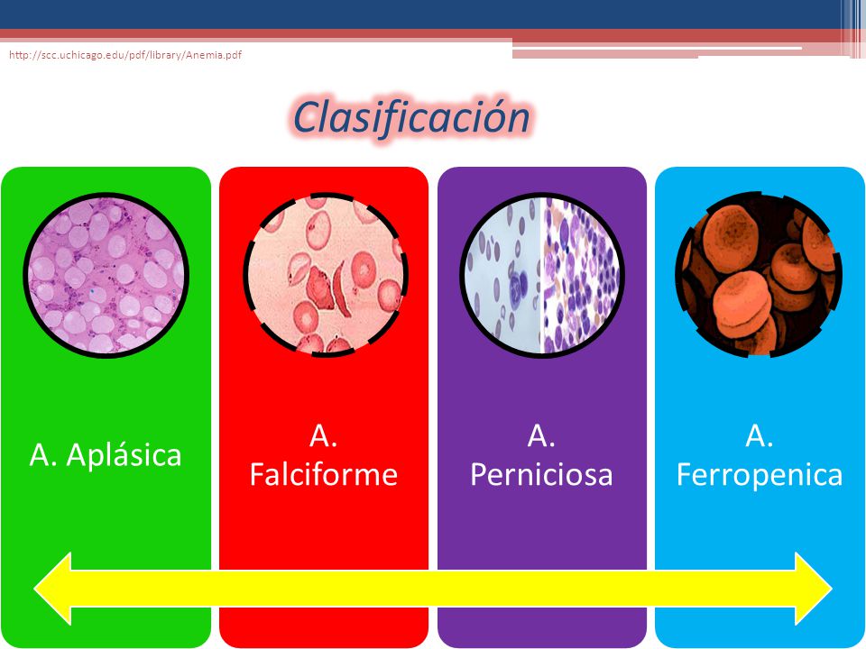 Clasificación A. Aplásica A. Falciforme A. Perniciosa A. Ferropenica