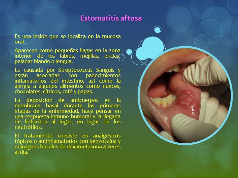 Estomatitis aftosa Es una lesión que se localiza en la mucosa oral.