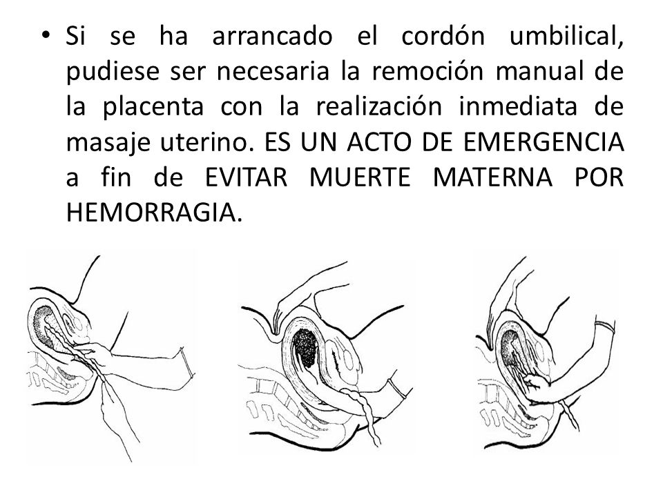 Si se ha arrancado el cordón umbilical, pudiese ser necesaria la remoción manual de la placenta con la realización inmediata de masaje uterino.