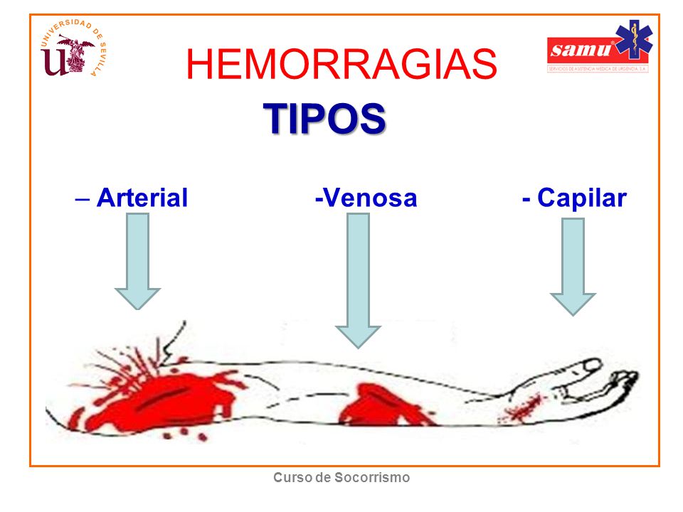 HEMORRAGIAS Arterial -Venosa - Capilar TIPOS Curso de Socorrismo