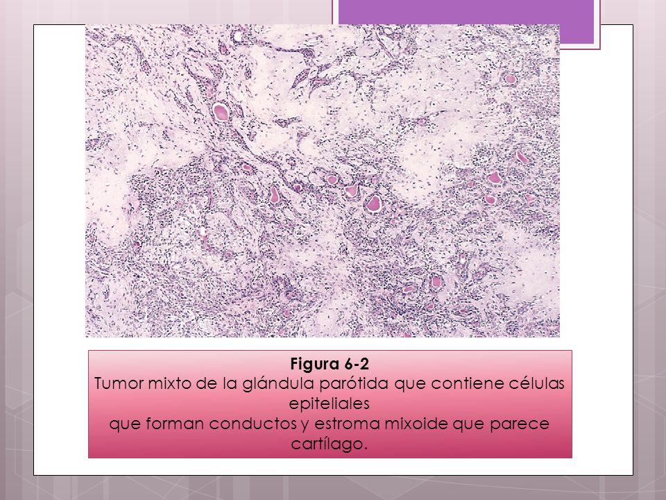 Tumor mixto de la glándula parótida que contiene células epiteliales