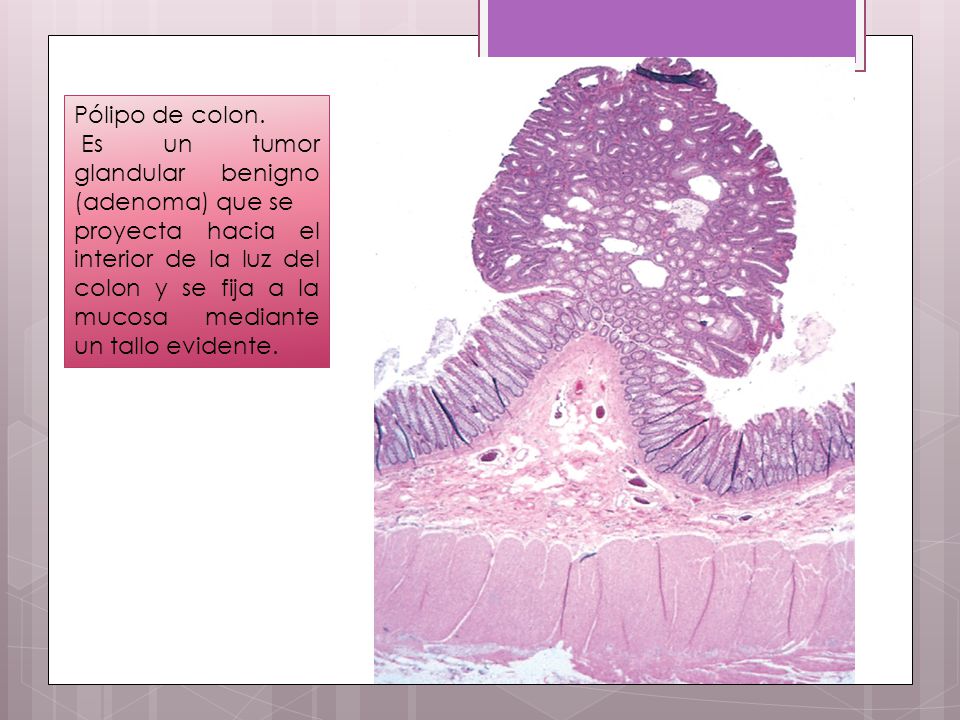 Pólipo de colon. Es un tumor glandular benigno (adenoma) que se.