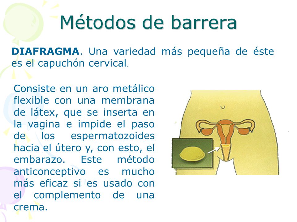 Métodos de barrera DIAFRAGMA. Una variedad más pequeña de éste es el capuchón cervical.