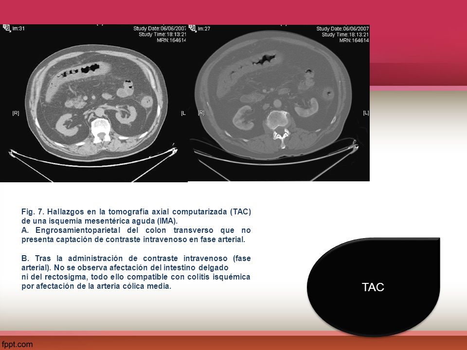 Fig. 7. Hallazgos en la tomografía axial computarizada (TAC) de una isquemia mesentérica aguda (IMA).
