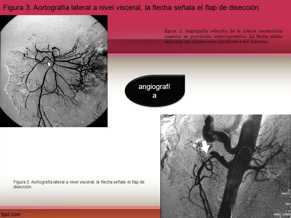 Figura 3. Aortografía lateral a nivel visceral, la flecha señala el flap de disección.