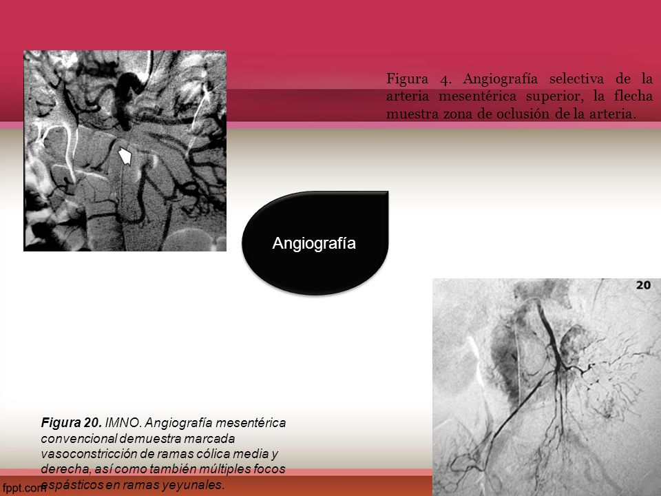 Figura 4. Angiografía selectiva de la arteria mesentérica superior, la flecha muestra zona de oclusión de la arteria.