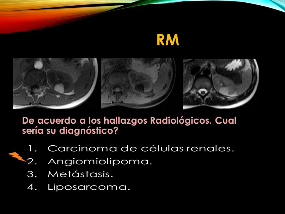 RM De acuerdo a los hallazgos Radiológicos. Cual sería su diagnóstico