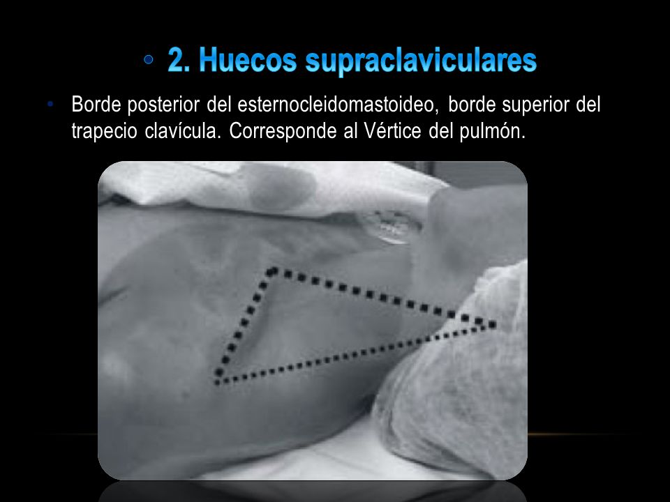 2. Huecos supraclaviculares