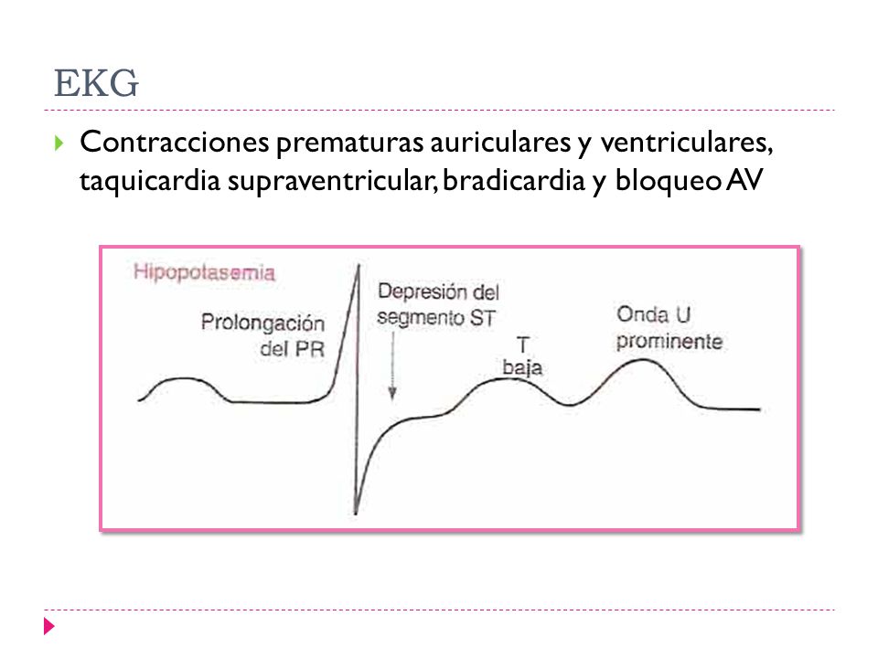 EKG Contracciones prematuras auriculares y ventriculares, taquicardia supraventricular, bradicardia y bloqueo AV.