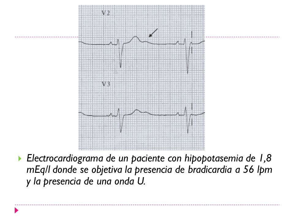 Electrocardiograma de un paciente con hipopotasemia de 1,8 mEq/l donde se objetiva la presencia de bradicardia a 56 lpm y la presencia de una onda U.