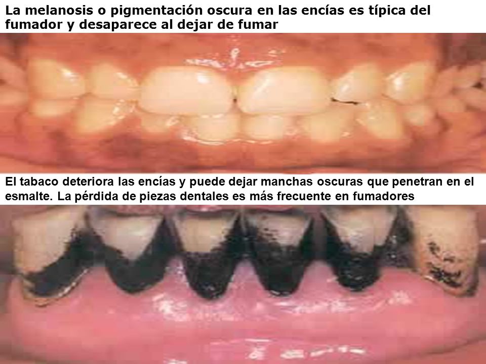 La melanosis o pigmentación oscura en las encías es típica del fumador y desaparece al dejar de fumar