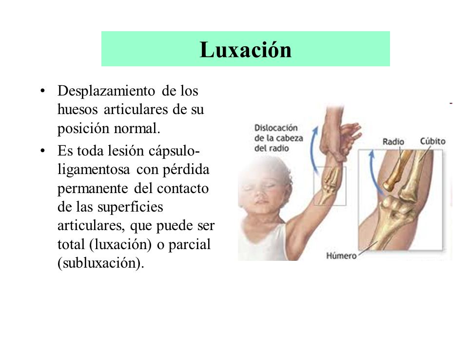Luxación Desplazamiento de los huesos articulares de su posición normal.