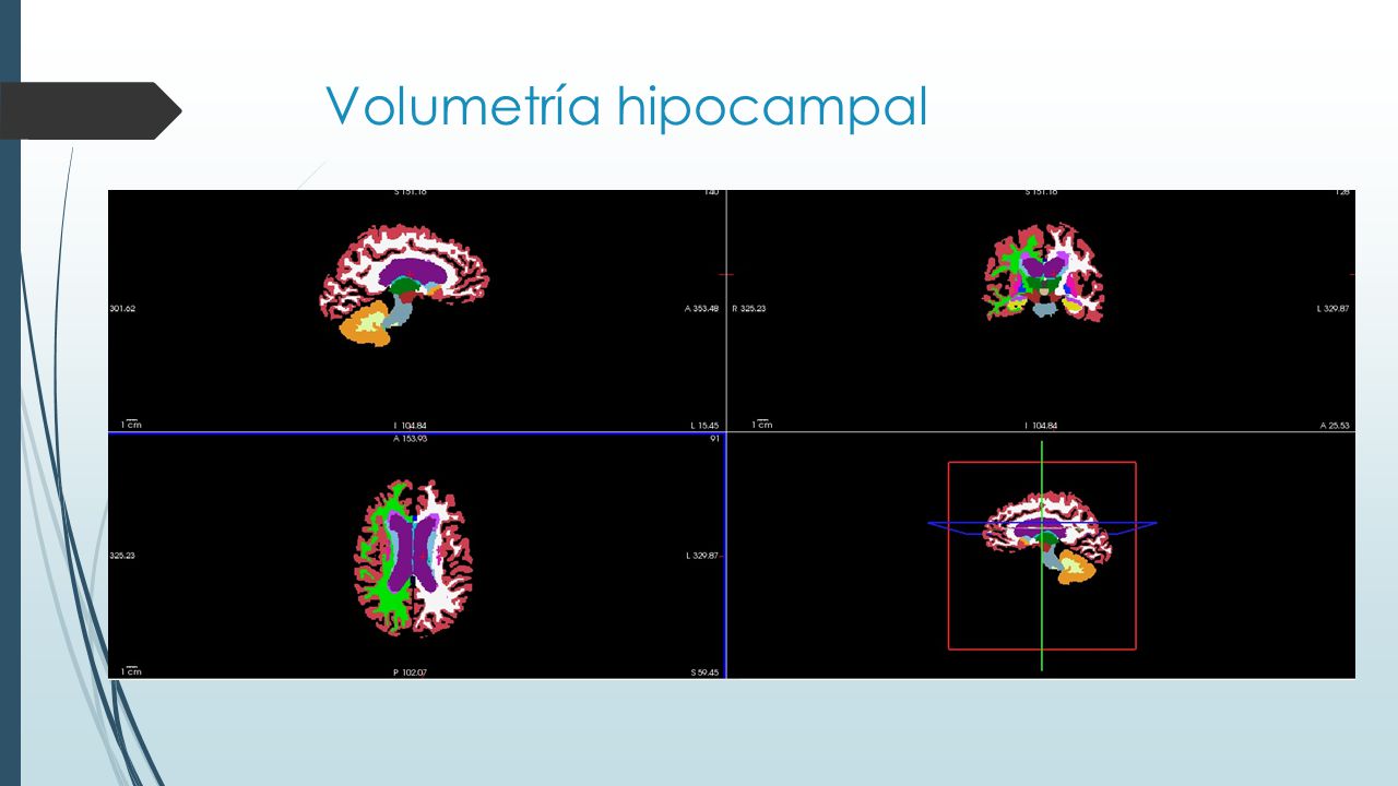 Volumetría hipocampal