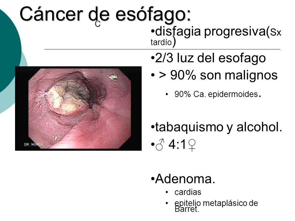 Cáncer de esófago: disfagia progresiva(Sx tardío) 2/3 luz del esofago