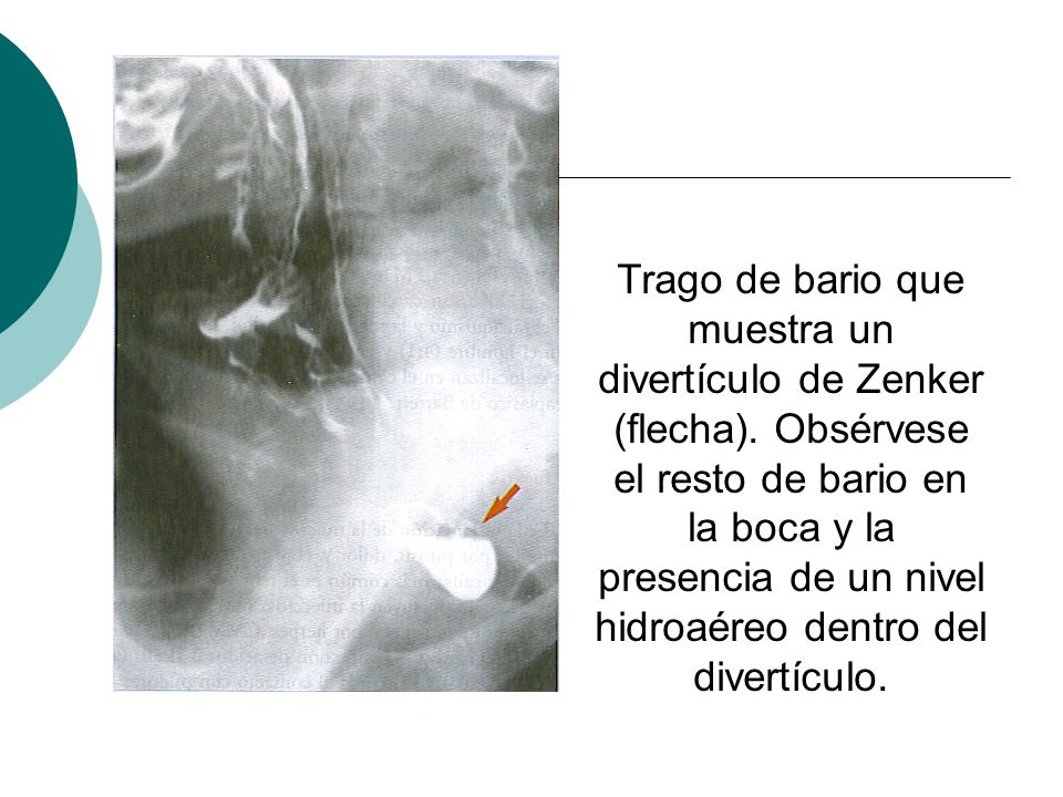 Trago de bario que muestra un divertículo de Zenker (flecha)