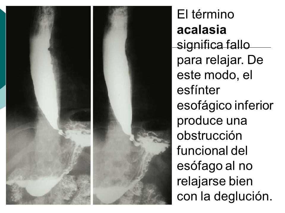 El término acalasia significa fallo para relajar. De este modo, el