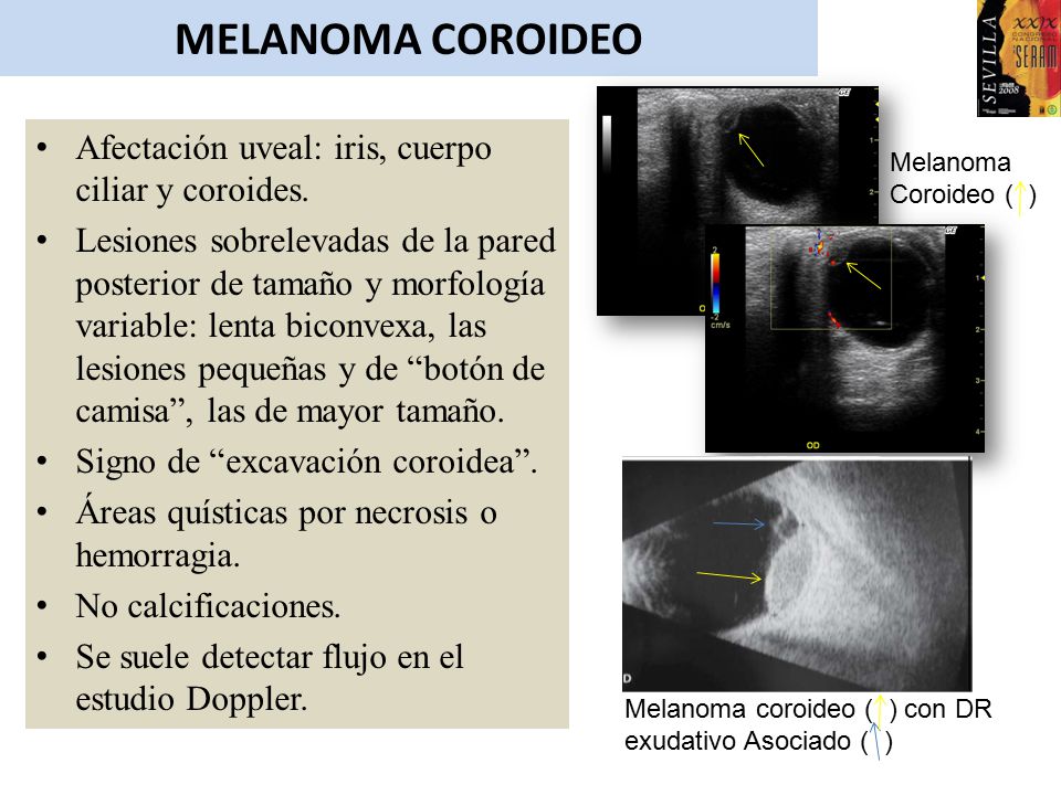 MELANOMA COROIDEO Afectación uveal: iris, cuerpo ciliar y coroides.