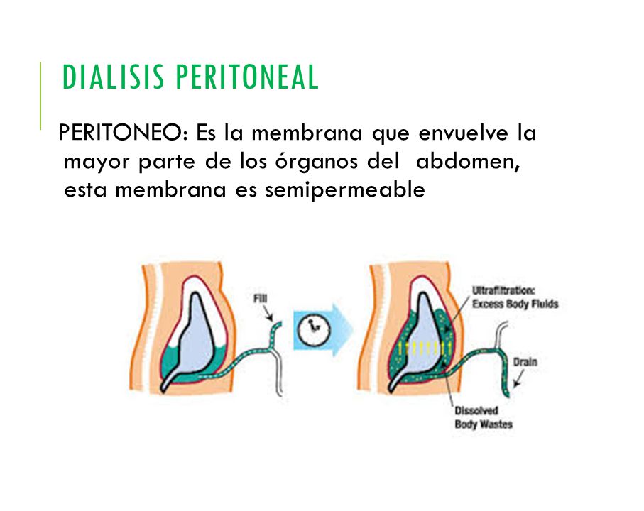 DIALISIS PERITONEAL PERITONEO: Es la membrana que envuelve la mayor parte de los órganos del abdomen, esta membrana es semipermeable.