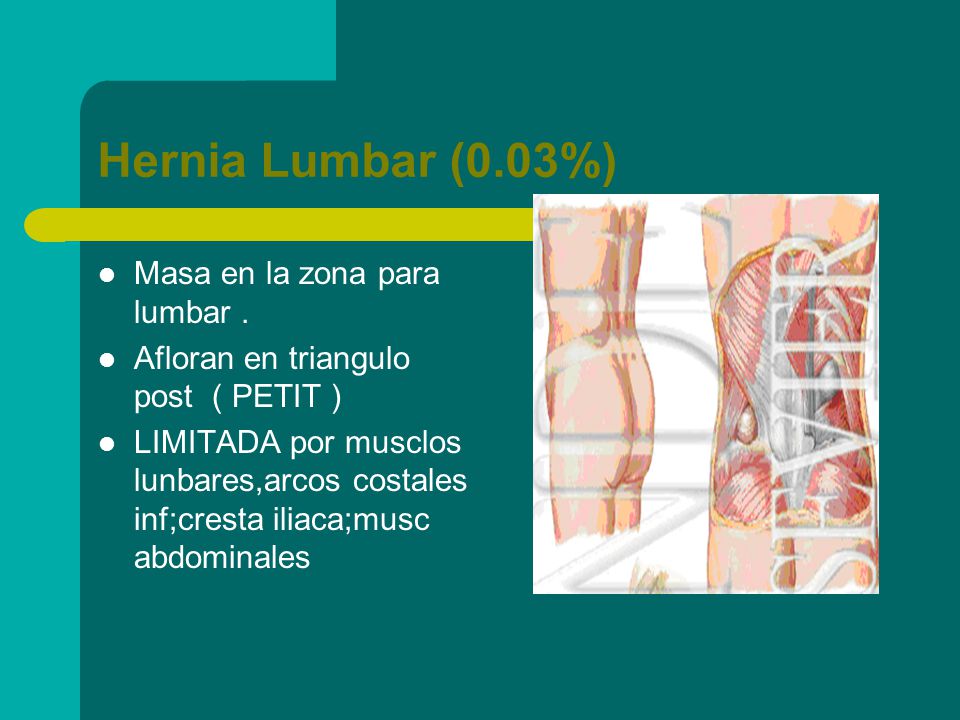 Hernia Lumbar (0.03%) Masa en la zona para lumbar .