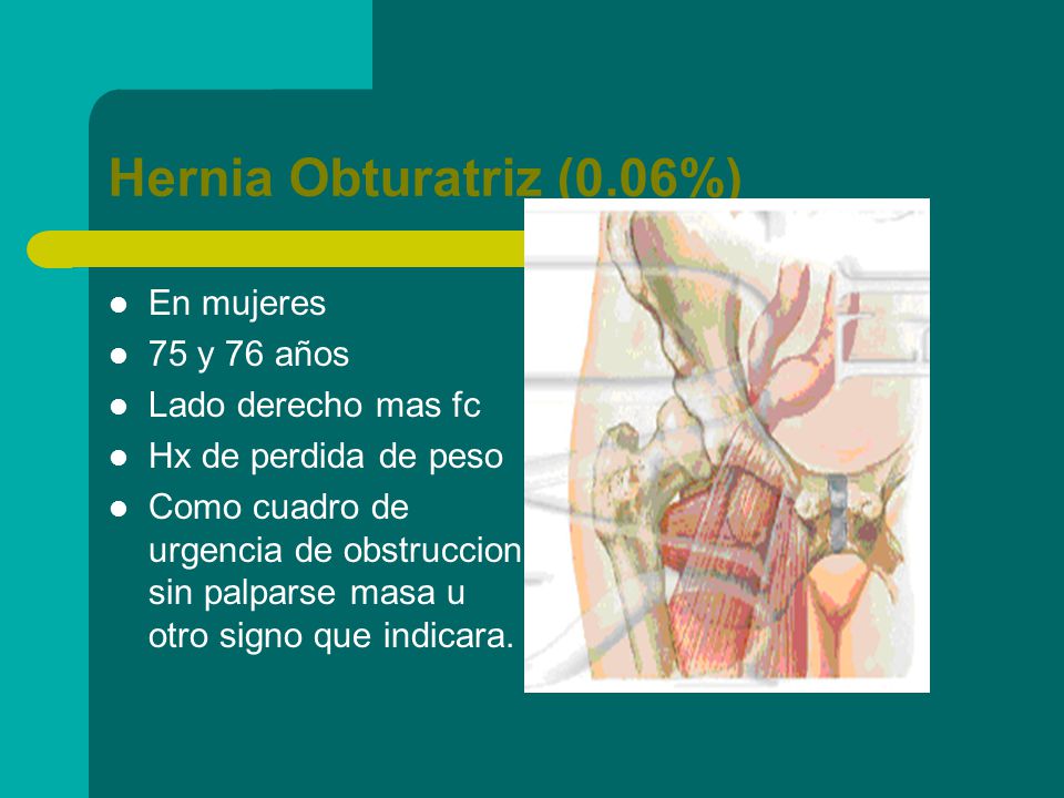 Hernia Obturatriz (0.06%) En mujeres 75 y 76 años Lado derecho mas fc