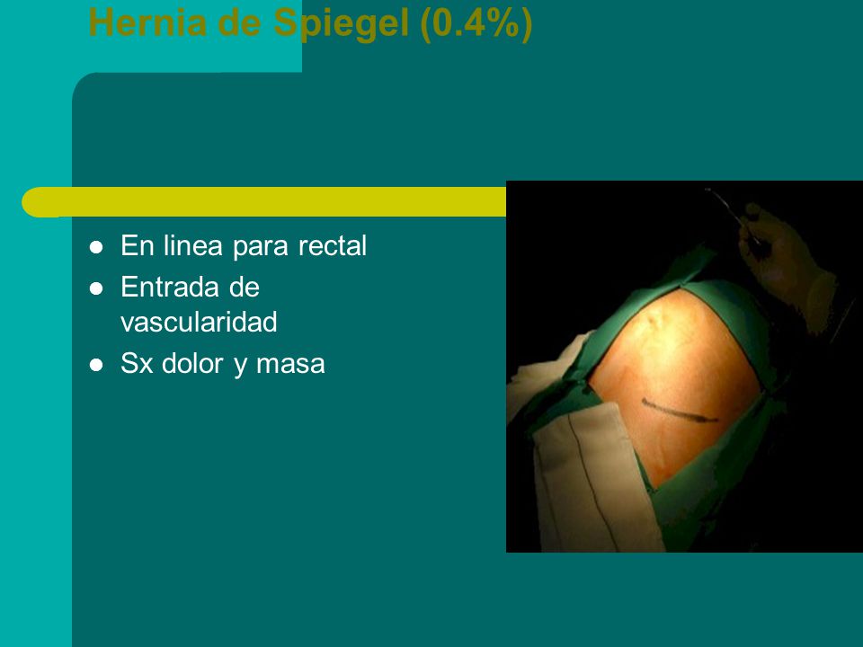 Hernia de Spiegel (0.4%) En linea para rectal Entrada de vascularidad