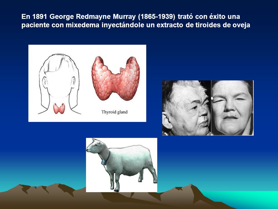 En 1891 George Redmayne Murray ( ) trató con éxito una paciente con mixedema inyectándole un extracto de tiroides de oveja
