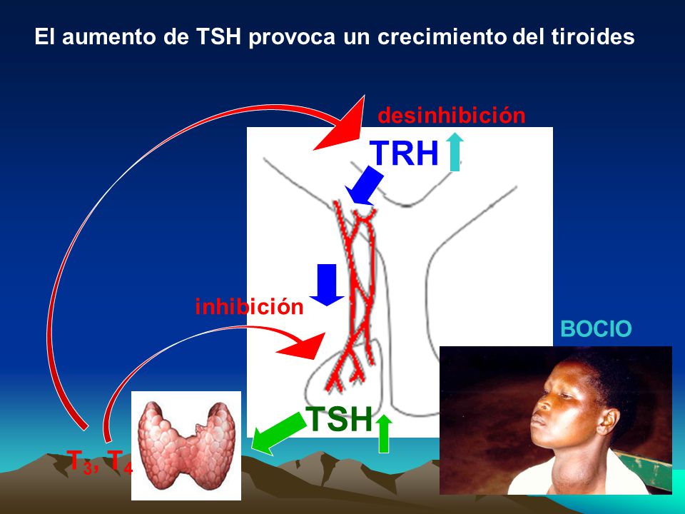 TRH TSH T3, T4 El aumento de TSH provoca un crecimiento del tiroides