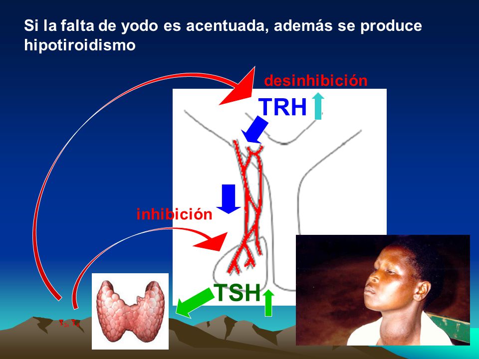 Si la falta de yodo es acentuada, además se produce hipotiroidismo